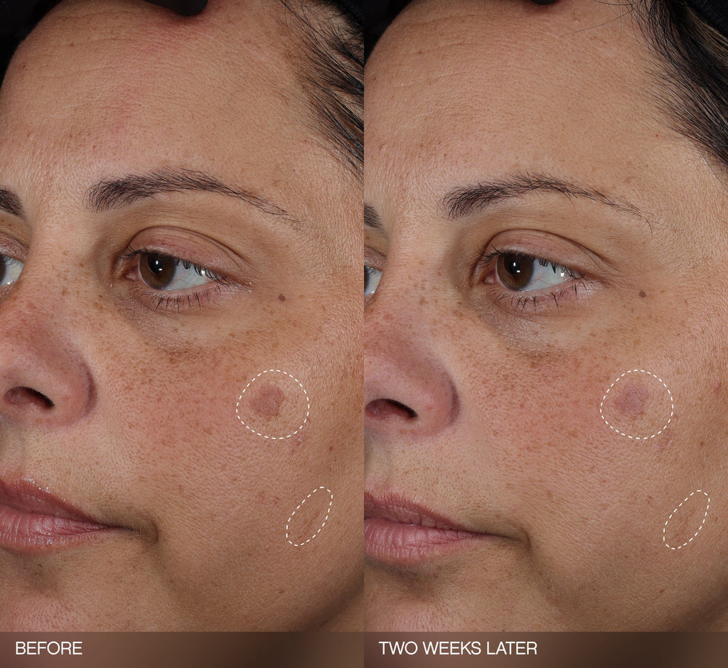 Brightening patches before-and-after showing reduced post-breakout dark spots on a light-skin-tone model's cheek after two weeks of use.