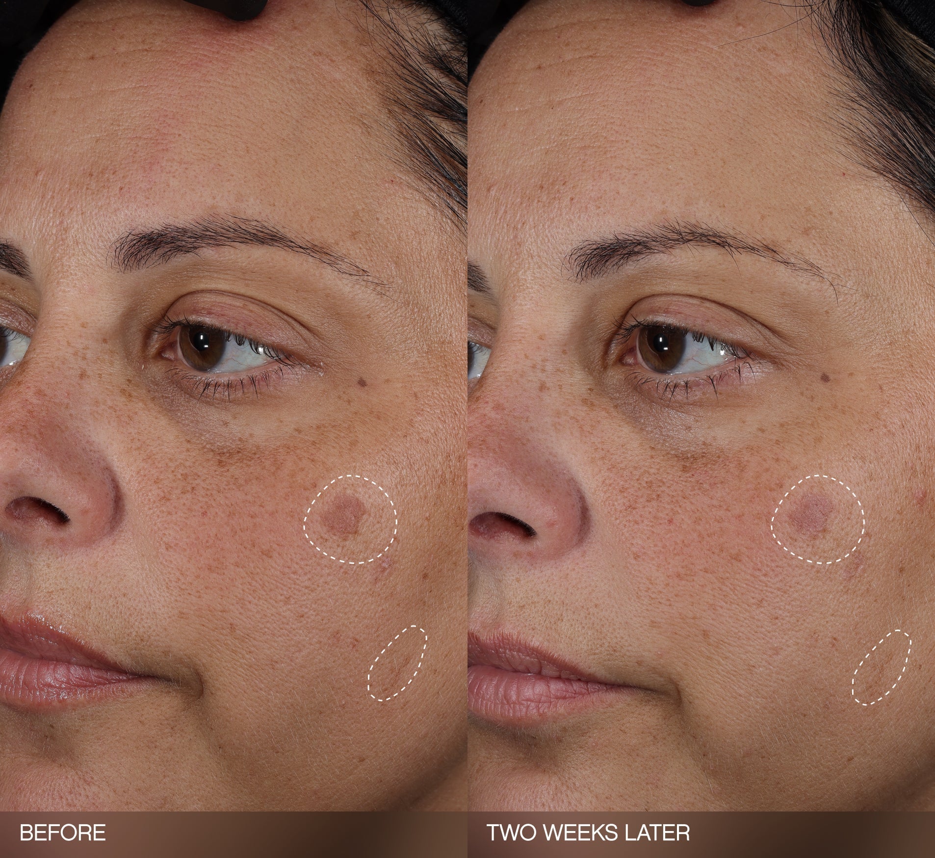 Brightening patches before-and-after showing reduced post-breakout dark spots on a light-skin-tone model's cheek after two weeks of use.