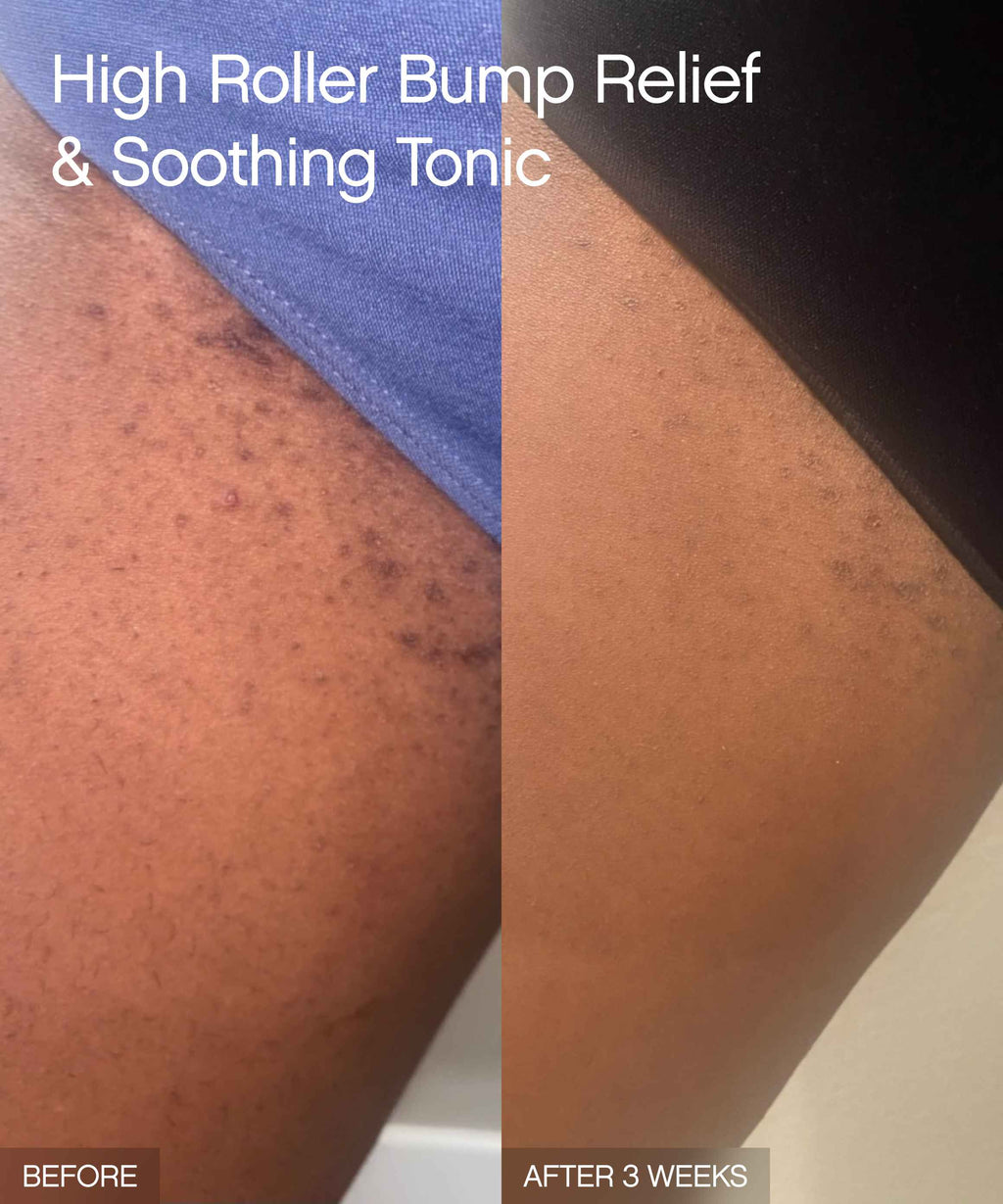 High Roller Bump Relief & Soothing Tonic
