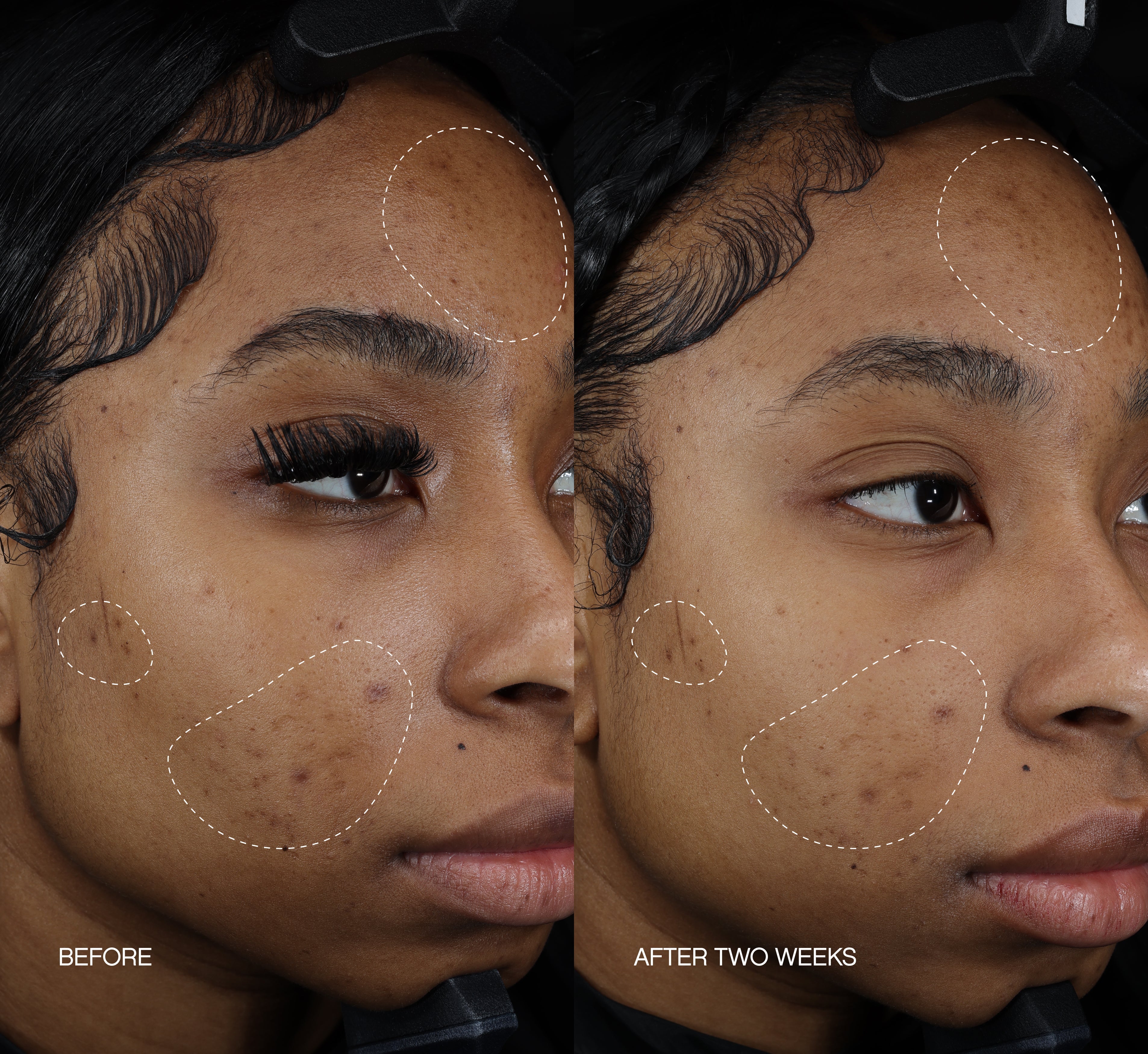 Before and after two-week comparison of dark spots on a face, with circled areas showing visible fading from a dark spot correcting serum.
